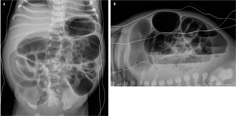 Approach To Imaging The Acute Abdomen In Pediatrics | Abdominal Key