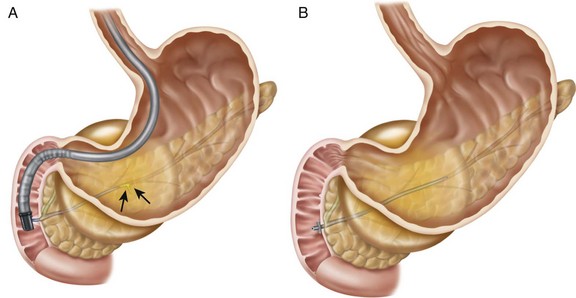 when to drain pancreatic pseudocyst - drainage of pancreatic pseudocyst