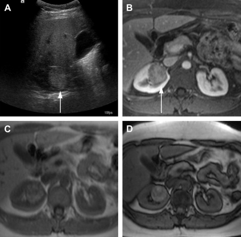 Contemporary Imaging of the Renal Mass | Abdominal Key