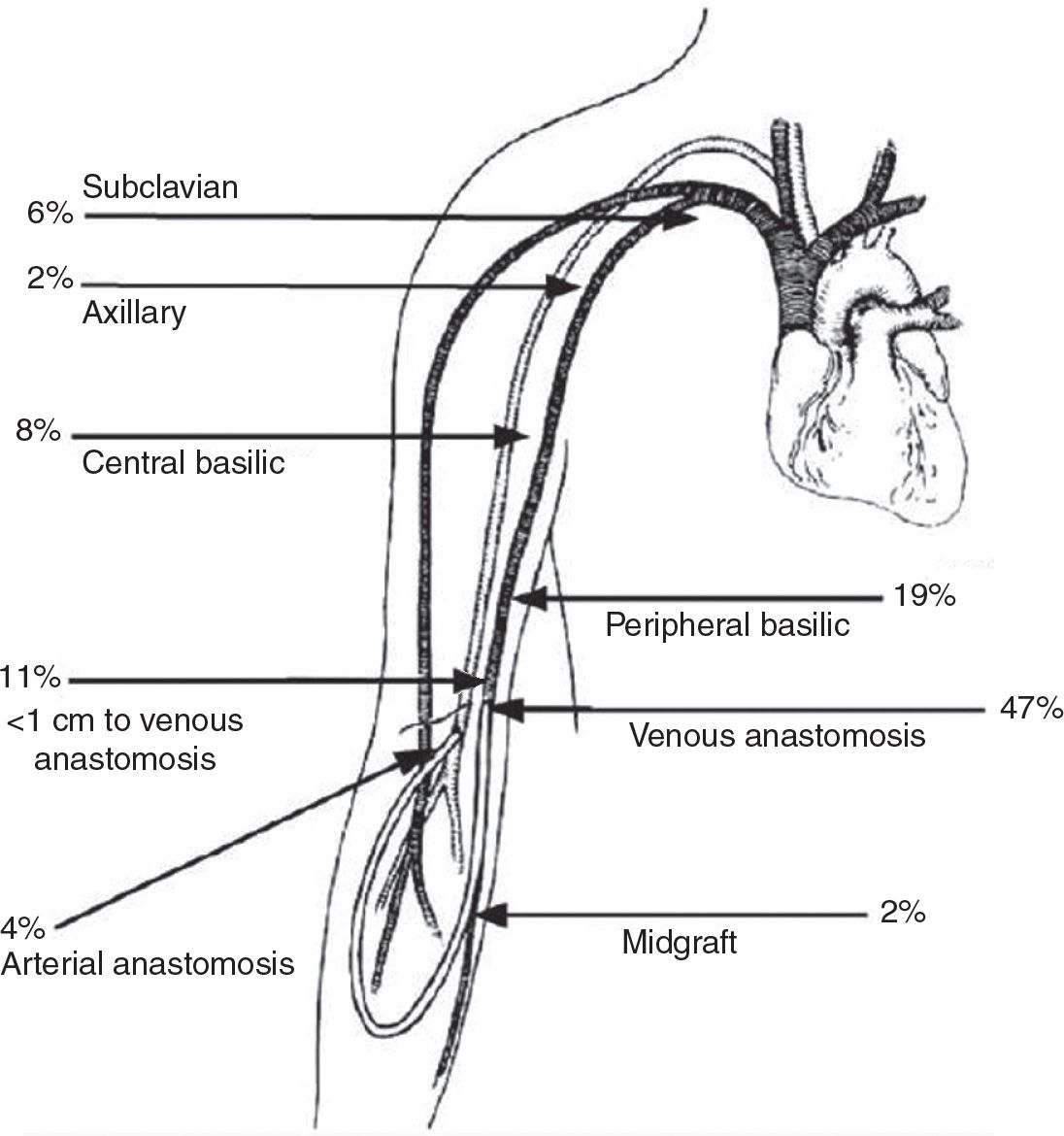 Arteriovenous Fistula Hemodialysis