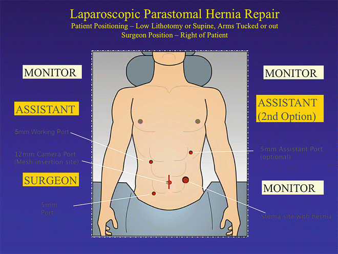 Hernia перевод с латинского. Laparoscopic Hernia Repair scheme.