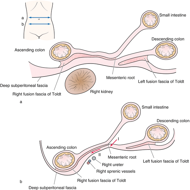 Laparoscopic Right Colectomy | Abdominal Key