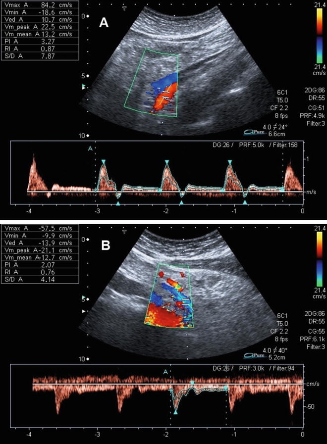 Ultrasound In Inflammatory Bowel Disease | Abdominal Key