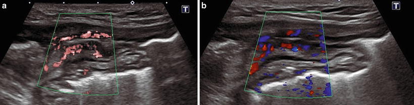 Ultrasound In Inflammatory Bowel Disease | Abdominal Key