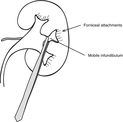 Applied Anatomy For Percutaneous Access | Abdominal Key