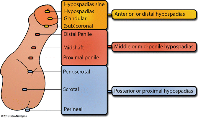 Hypospadias Variants | Abdominal Key