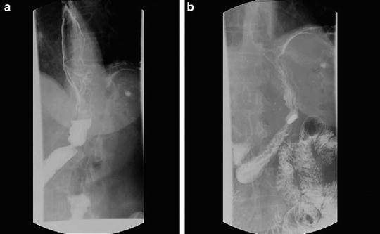 Laparoscopic Sleeve Gastrectomy: Management Of Complications ...