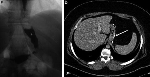 Laparoscopic Sleeve Gastrectomy: Management Of Complications ...