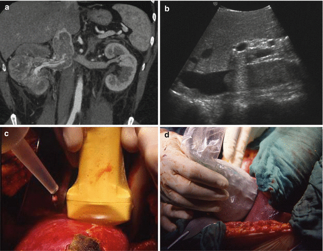 Intraoperative Ultrasound In Renal Surgery | Abdominal Key