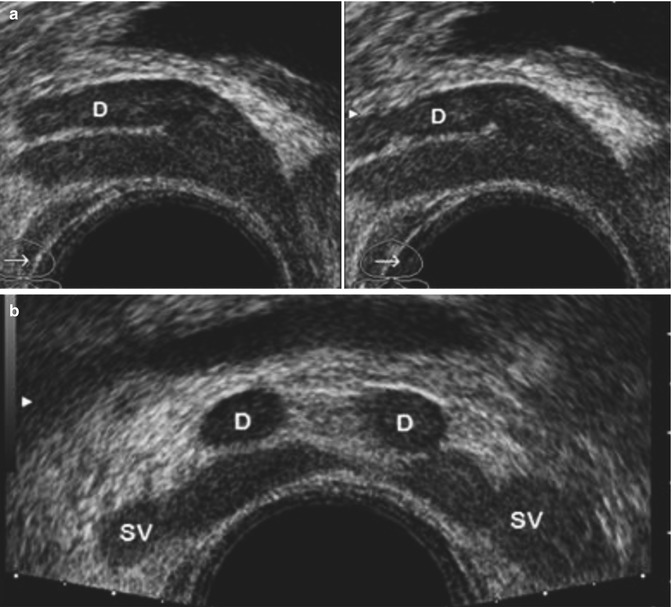 The Seminal Vesicles: Normal And Pathological Pictures | Abdominal Key