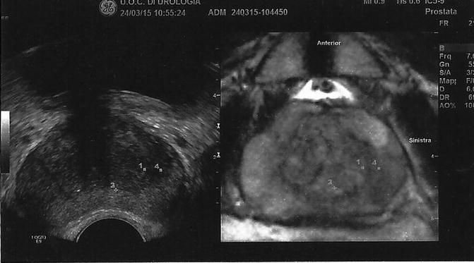 Interventional Ultrasound: Transperineal And Transrectal Prostatic ...