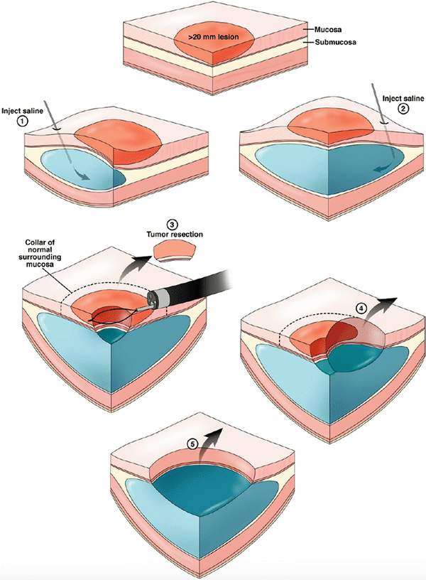 Endoscopic Mucosal Resection (EMR) | Abdominal Key