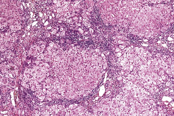 Cirrhosis Abdominal Key