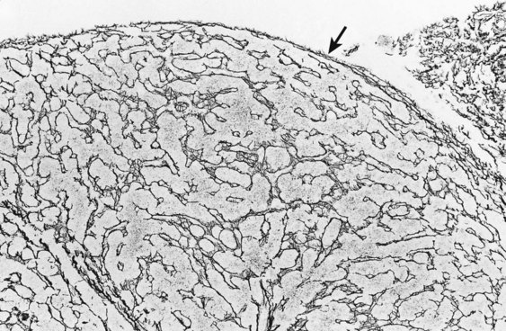 Cirrhosis Abdominal Key