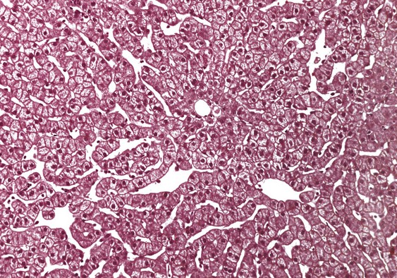 Cirrhosis Abdominal Key