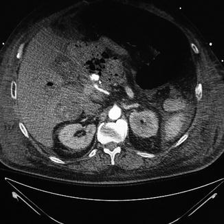 Orthotopic Liver Transplantation: Complications | Abdominal Key