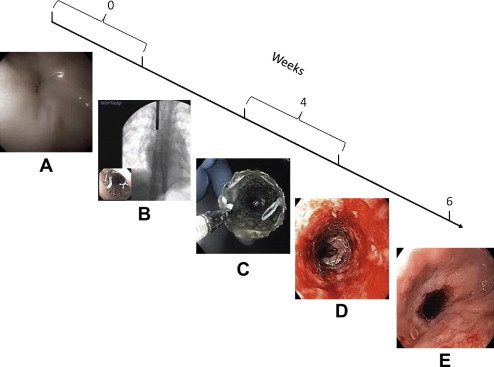 Expandable Stents For Benign Esophageal Disease | Abdominal Key