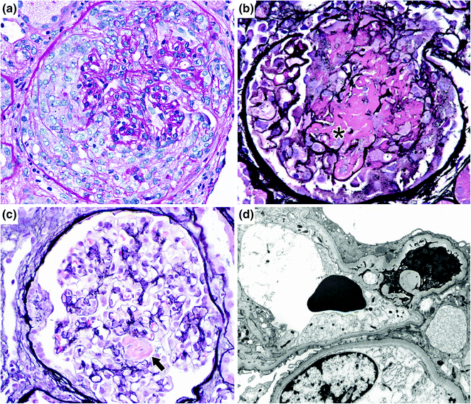 Glomerulonephritis Associated With Other Bacterial Infections ...