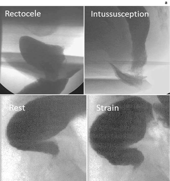 Constipation | Abdominal Key