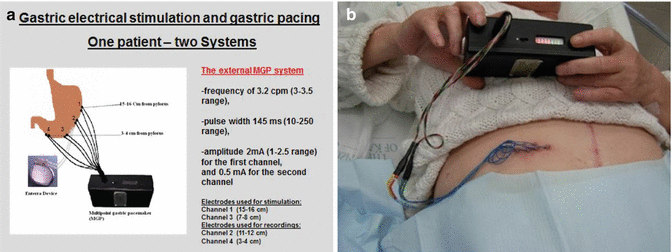 Gastric Electrical Stimulation, Pyloroplasty, Gastrectomy, And ...