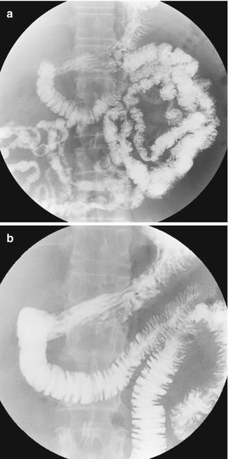 Gastric Functional Tests: Upper Gatrointestinal Barium Studies ...