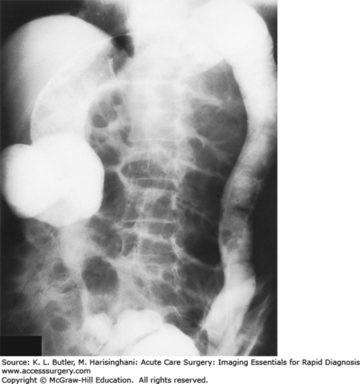 LARGE-BOWEL OBSTRUCTION | Abdominal Key