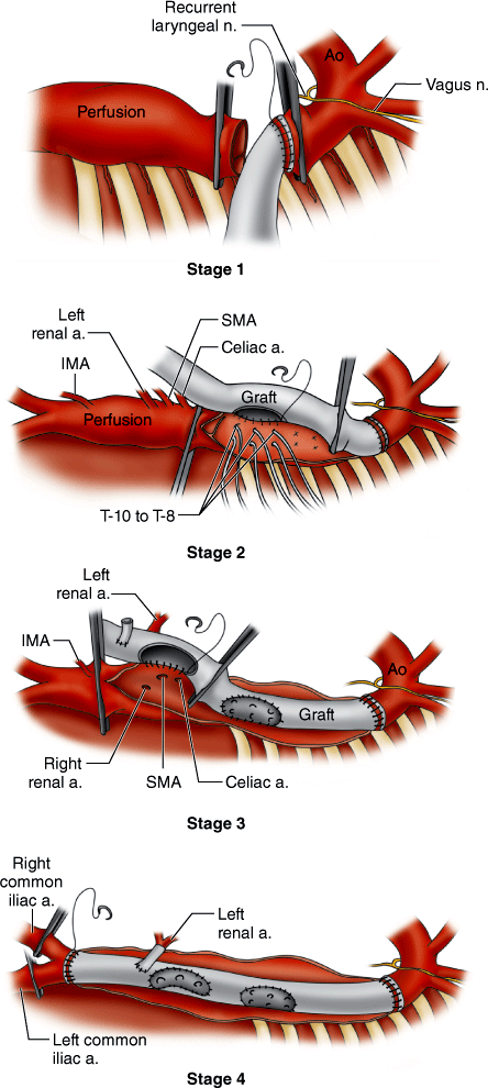 Endovascular Repair Of Thoracic Aortic Pathology | Abdominal Key