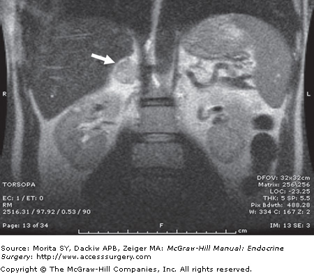 Multiple Endocrine Neoplasia Type 2 | Abdominal Key