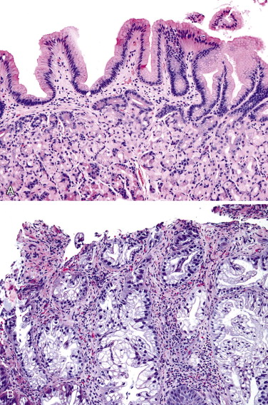 Epithelial Neoplasms Of The Esophagus | Abdominal Key