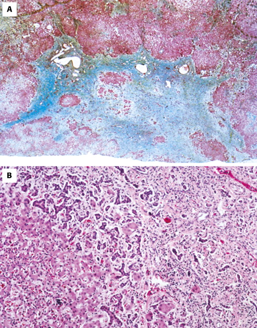 Liver Neoplasms | Abdominal Key