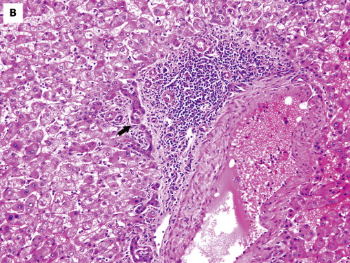 Liver Neoplasms | Abdominal Key