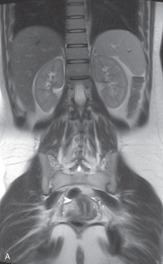 Imaging The Kidneys | Abdominal Key