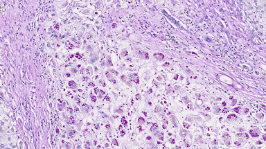 Liver Pathology | Abdominal Key