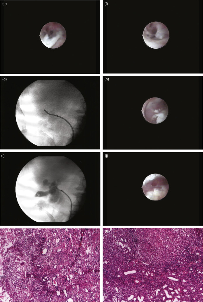 Diagnostic Ureteroscopy | Abdominal Key