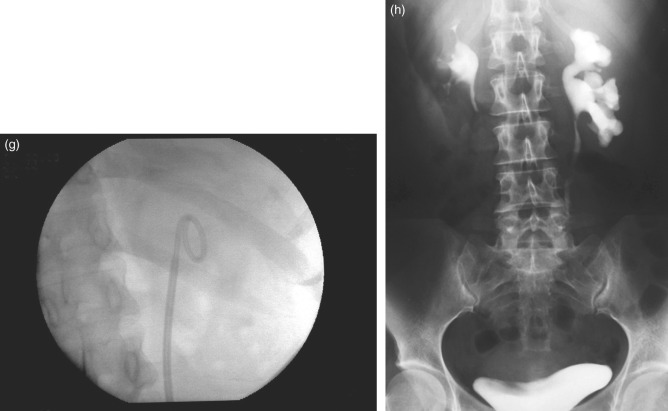 Retrograde Ureteroscopy In The Treatment Of Ureteropelvic Junction ...