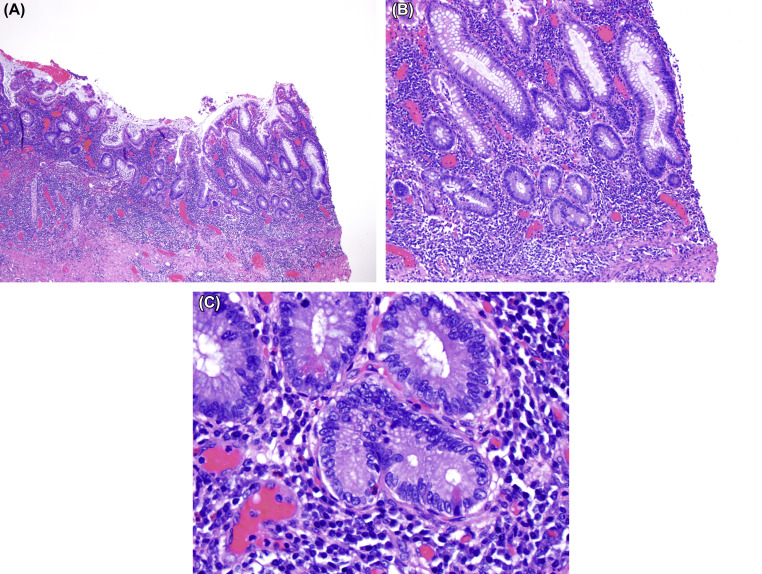 Overview Of Histopathology Of Ulcerative Colitis And Crohn’s Disease ...