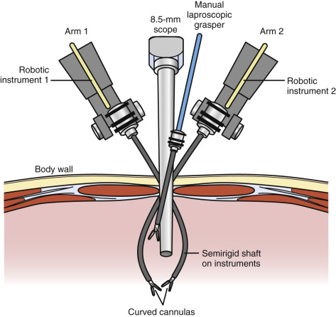 Basics Of Robotic Surgery | Abdominal Key