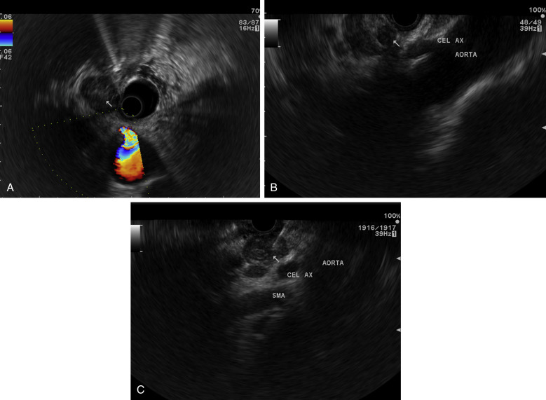 Endoscopic Ultrasound In Esophageal And Gastric Cancer | Abdominal Key