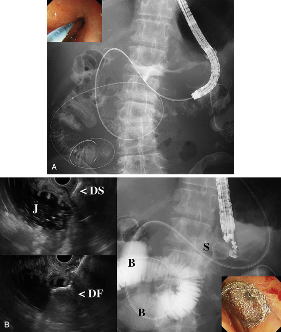 Endoscopic Ultrasonography-Guided Anastomosis, Drainage Of ...