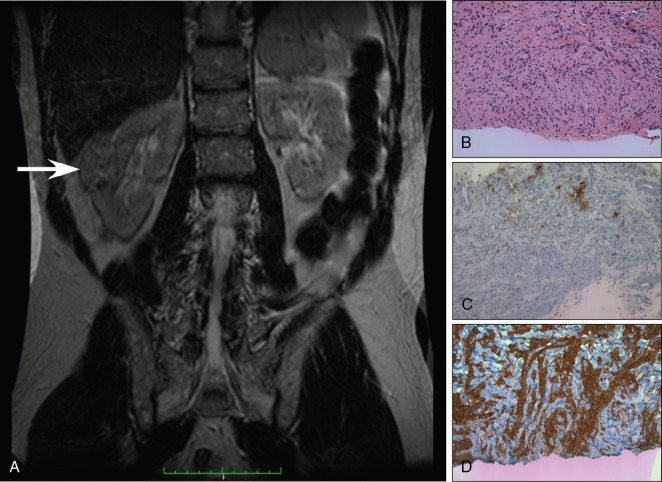 Tuberous Sclerosis Complex And The Kidney | Abdominal Key