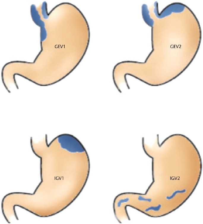 34 Portal Hypertension, Varices, Gastropathy, And Gastric Antral ...