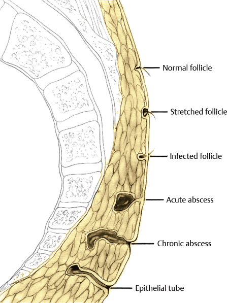 10 Pilonidal Disease | Abdominal Key