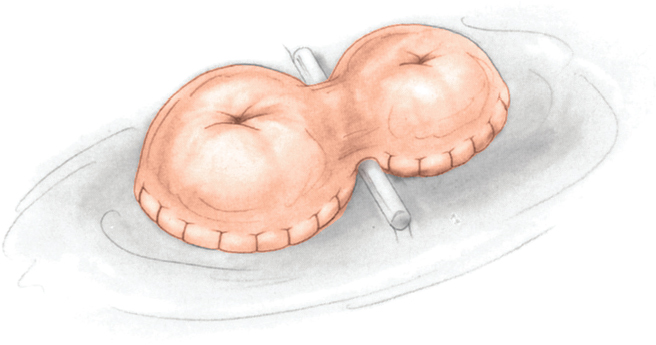 32 Intestinal Stomas | Abdominal Key