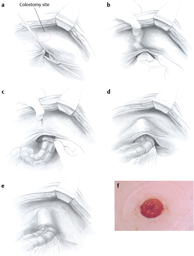 32 Intestinal Stomas | Abdominal Key