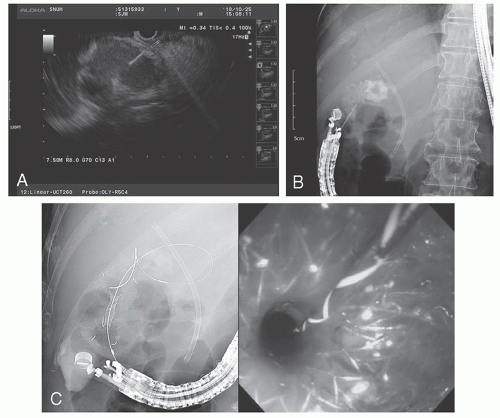 EUS-Guided Biliary Drainage | Abdominal Key