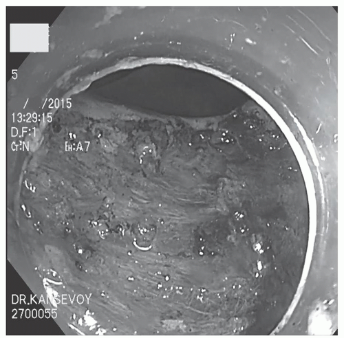 Colon Endoscopic Submucosal Dissection | Abdominal Key