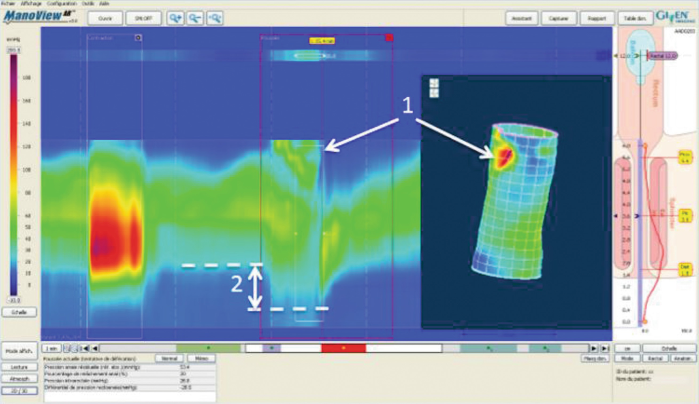 Between Conventional Anorectal Manometry And High Resolution/High ...