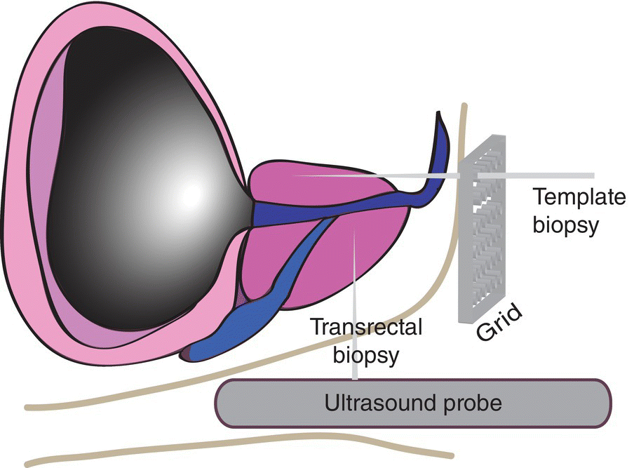 Prostate Neoplasm | Abdominal Key