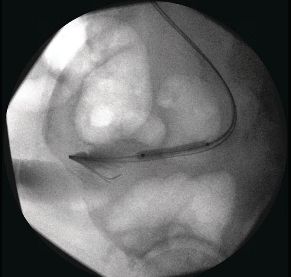 Endoscopic Management Of Ureteroenteric Strictures | Abdominal Key