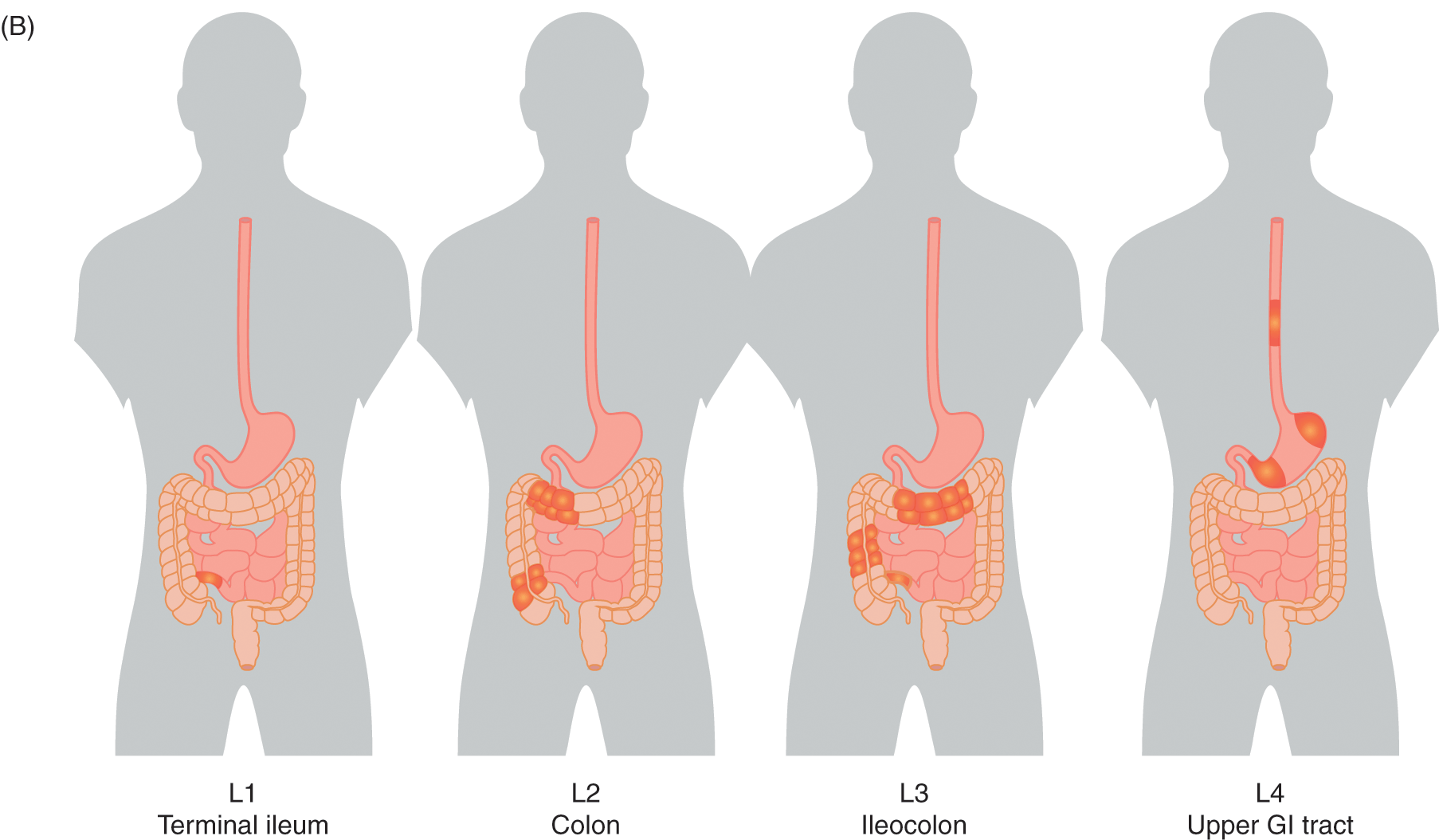 Chapter 21 – Inflammatory Bowel Disease Diagnosis | Abdominal Key